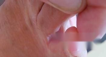 脚上长鸡眼怎么办?6个妙方巧帮忙