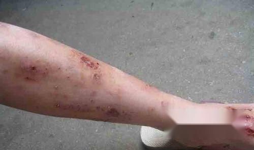 腿部湿疹日常护理