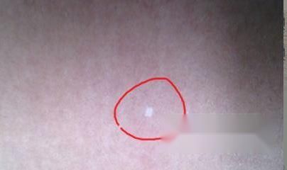 贫血痣是什么？如何治疗？