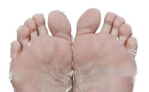 脚底脱皮是怎么回事？该怎么办？