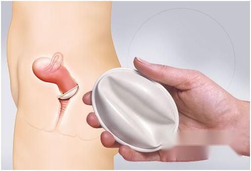 子宫帽是什么？子宫帽的使用方法