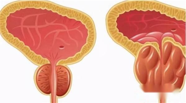 前列腺炎前期症状主要是：大腿根痛，医生说吃红霉素就可以了？