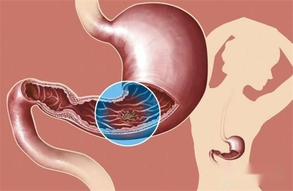 水煮蛋吃多了会引起胃炎 医生建议：这3种食物可多吃 帮助养胃