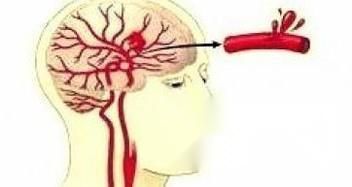 有哪些人容易患脑溢血