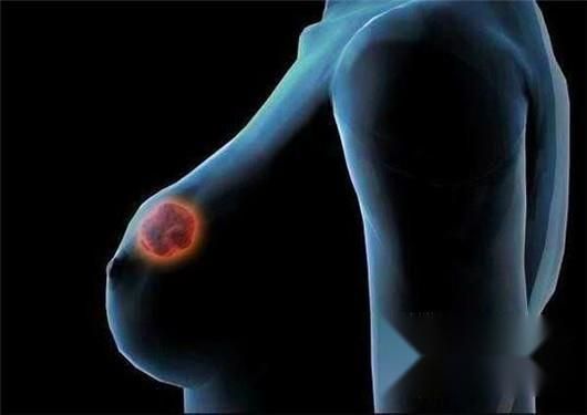 乳房有肿块是什么原因？该如何消除乳房肿块？