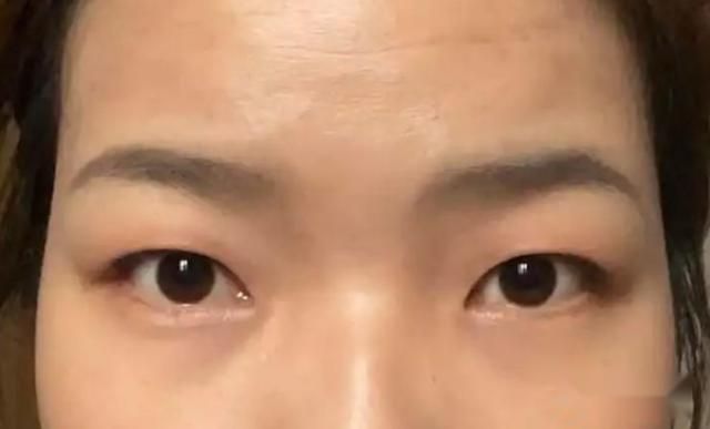 眼睛肿眼泡是如何造成的